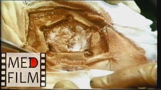 Трепанация черепа, опухоль мозга © surgical opening into the skull