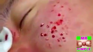 10 zits at once - Mr.Pimple