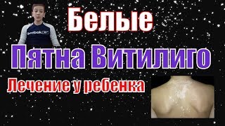 Белые Пятна Витилиго у Ребенка - Ребенок Вылечил Витилиго - большие и маленькие белые пятна на теле