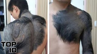 Top 10 Craziest Birth Marks