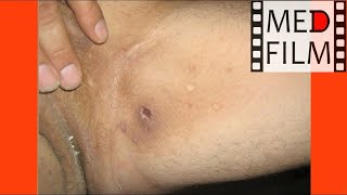 Паховая эпидермофития © Epidermophyton