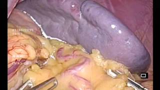 Laparoscopic Splenectomy