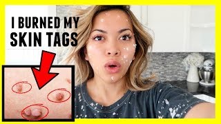 REMOVING SKIN TAGS ON MY FACE!