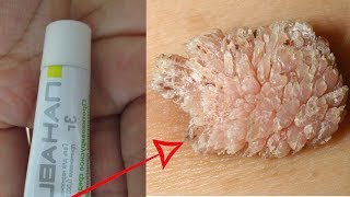 Почему Врачи Молчат? Мази Лечащие Папилломы