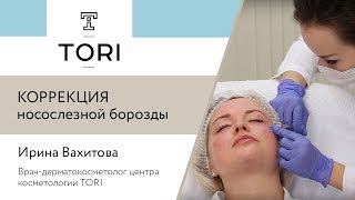 Коррекция носослезной борозды