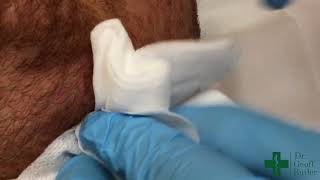 Drainage of an Abscess along the Jaw Line