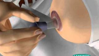 Latch Assist UK WMV