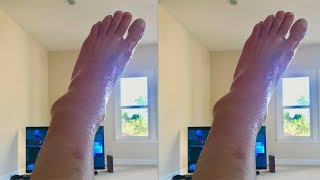 I BROKE MY ANKLE!