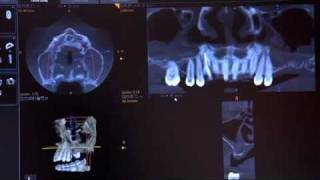 Antral Sinus Bone Graft Pre-Treatment Evaluation with the CS 9300