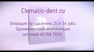 Операция по удалению 25 и 34 зуба. Одномоментная имплантация системой ASTRA TECH.