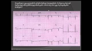 მარცხენა პარკუჭის ჰიპერტროფია ამპლიტუდური კრიტერიუმებით / სტუდენტის ელექტროკარდიოგრამა