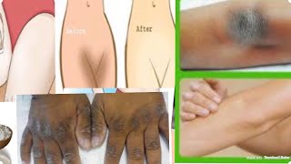 dark knuckles, Inner thighs, knees, armpits, uneven skin tone? No more