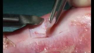 La greffe épithélio-conjonctive ou greffe gingivale libre