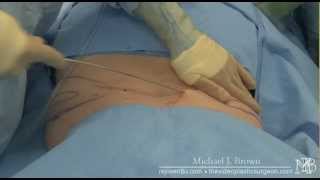 Liposuction of the back, flanks or 'love handles'