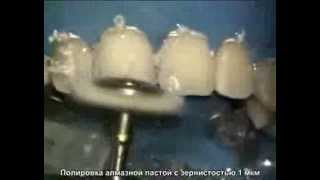 Реставрация передних зубов.