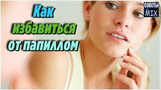 Как избавиться от папиллом в домашних условиях очень простым способом