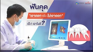 ฟันคุด ทิ้งไว้นาน ถ้าไม่เอาออกจะเกิดถุงน้ำและเนื้องอกจริงหรือ? | Digital Dental Center