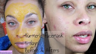I TRIED TURMERIC FACE MASKS FOR 5 DAYS - RESULTS - ACNE PRONE SKIN