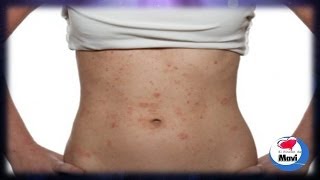 Remedios caseros para el tratamiento de la dermatitis - Cuidado de la piel