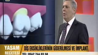 implant fiyatları nasıldır , implant nedir ve İmplant bakımı nasıl olmalıdır - Tanfer Klinik