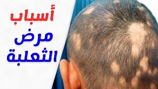 اسباب الاصابة بمرض الثعلبة وطرق علاجه نهائيا بالاعشاب