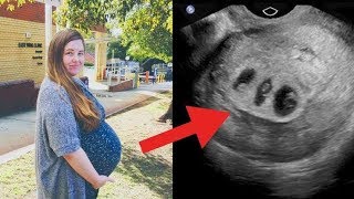 Kadın Hamile Olduğunu Düşünüyordu, Doktor Ultrasona Bakınca Gözlerine İnanamadı