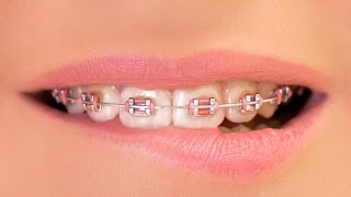 CEPILLO VITIS Y LA LIMPIEZA DE LOS DIENTES AL USAR BRACKETS U ORTODONCIA, Ekirita Love