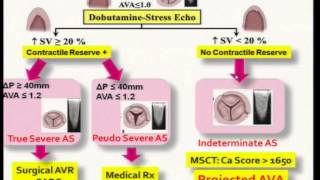 6_4 Dr Amrish Agarwal- Low Flow low Gradient Aortic Stenosis with LV Dysfunction at WCCPCI 2014