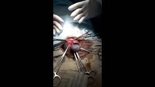 Testicular torsion/Перекрут яичка