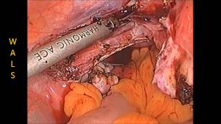 Total Laparoscopic Hysterectomy by Dr. R.K. Mishra