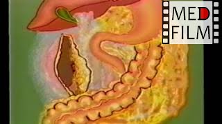 Расширенная гастропанкреатодуоденальная резекция © gastropankreatoduodenalnaya resection