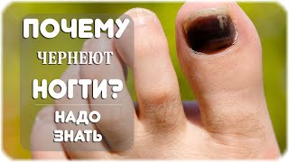 Как и почему чернеют ногти на ногах?