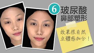 [水微晶]玻尿酸鼻部塑型-混血美鼻