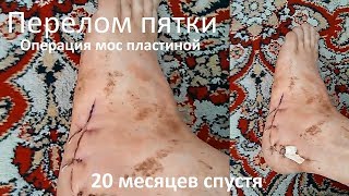 Перелом пятки левой закрытый осколочный со смещением Операция мос пластиной 20 месяцев спустя...