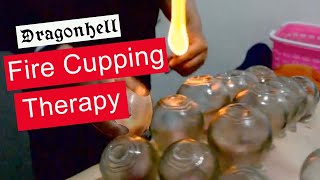 Fire Cupping therapy ✅ Master of Traditional Chinese Medicine TCM Dragonhell LingLingBW