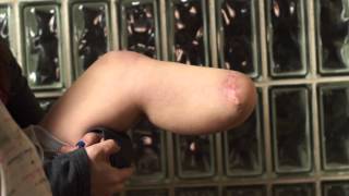 AmputeeOt: Moving the muscles of my Below Knee amputation, close up