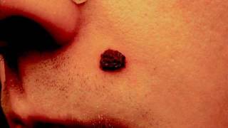 Natural Mole Removal at home