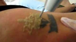 Laser Tattoo Removal