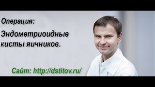 Эндометриоидные кисты яичников