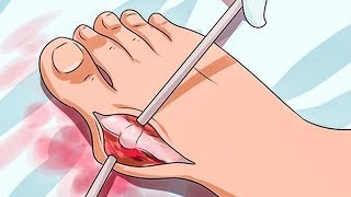 Если ВЫПИРАЕТ Косточка на Ноге, Не Спешите ЛОЖИТСЯ под НОЖ! Тем, кто Страдает от ЭТОЙ Проблемы ...