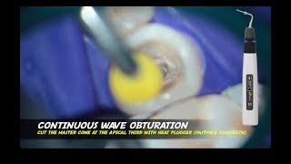 Fast Pack & fast fill For 3D Obturation System eighteeth continuous wave warm vertical fiber post