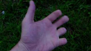 Partial Hand Amputee
