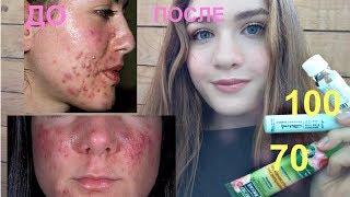 ДЕШЕВЫЕ СРЕДСТВА ОТ ПРЫЩЕЙ | КАК ДАВИТЬ ПРЫЩИ | ЭТАПЫ УХОДА ЗА ЖИРНОЙ КОЖЕЙ