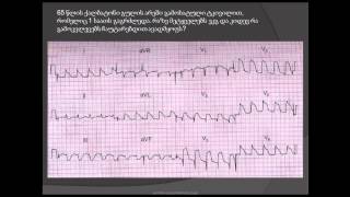 ეკგ წაკითხვა. მიოკარდიუმის წინა-გვერდითი ინფარქტი (miokardiumis wina-gverditi infarqti)