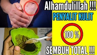 KABAR BAHAGIA!! Obat Penyakit Kulit Gatal, Eksim & Gatal Menahun|Cara Mengobati Penyakit Kulit Eksim