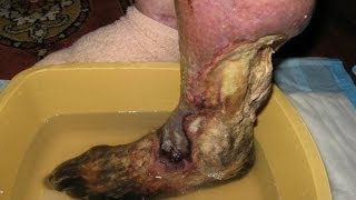 Krokodil: Highly Addictive Flesh-Eating 'Zombie Drug' Wreaks Havoc