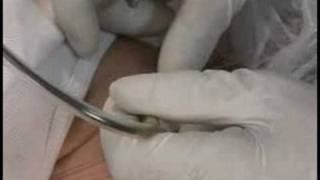 Electrolysis Hair Removal : Electrolysis Back of Neck Hair Removal Treatment