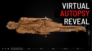 Virtual autopsy on 150-year-old remains shows how smallpox colonizes the human body