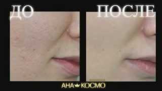 Лазерный пилинг и шлифовка шрамов