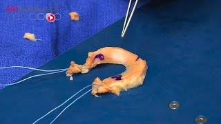 Chirurgie du genou : la greffe de ménisque - Allô Docteurs